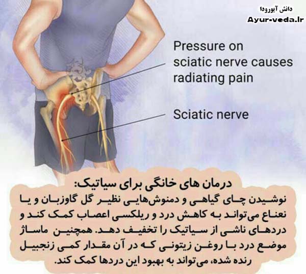 درمان خانگي سياتيك