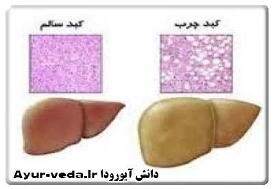 درمان کبد چرب با روش های طبیعی و گیاهی